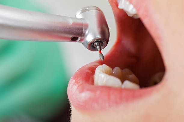 Best Knocked-Out Tooth (Avulsed Tooth) Treatment in Amite City, LA